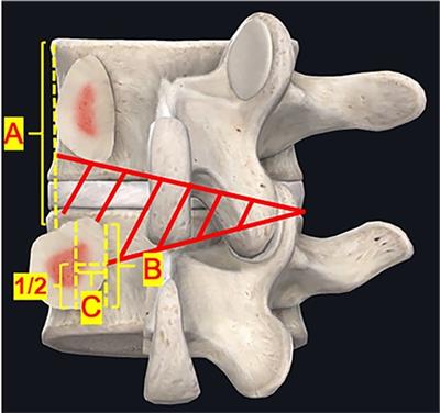 Clinical efficacy and imaging outcomes of unilateral biportal endoscopy with unilateral laminotomy for bilateral decompression in the treatment of severe lumbar spinal stenosis